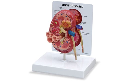 Kidney Model with Pathologies.jpg